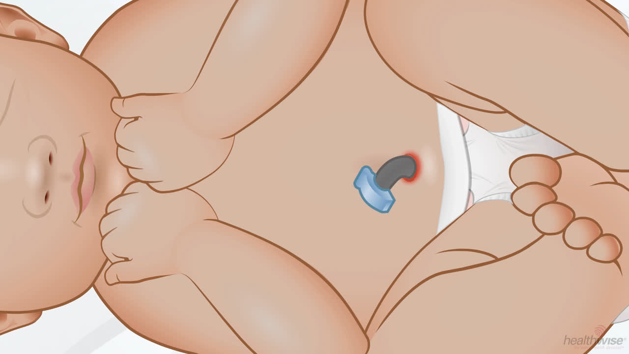 Umbilical Granuloma Umbilical Cord Why Is Pus Coming Out Of My