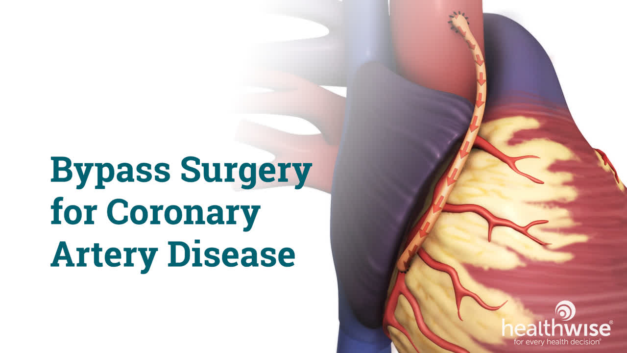 健康・医学 Coronary Artery Bypass Surgery CABG-Coronary Artery Bypass Grafting | Bangkok Heart Hospital