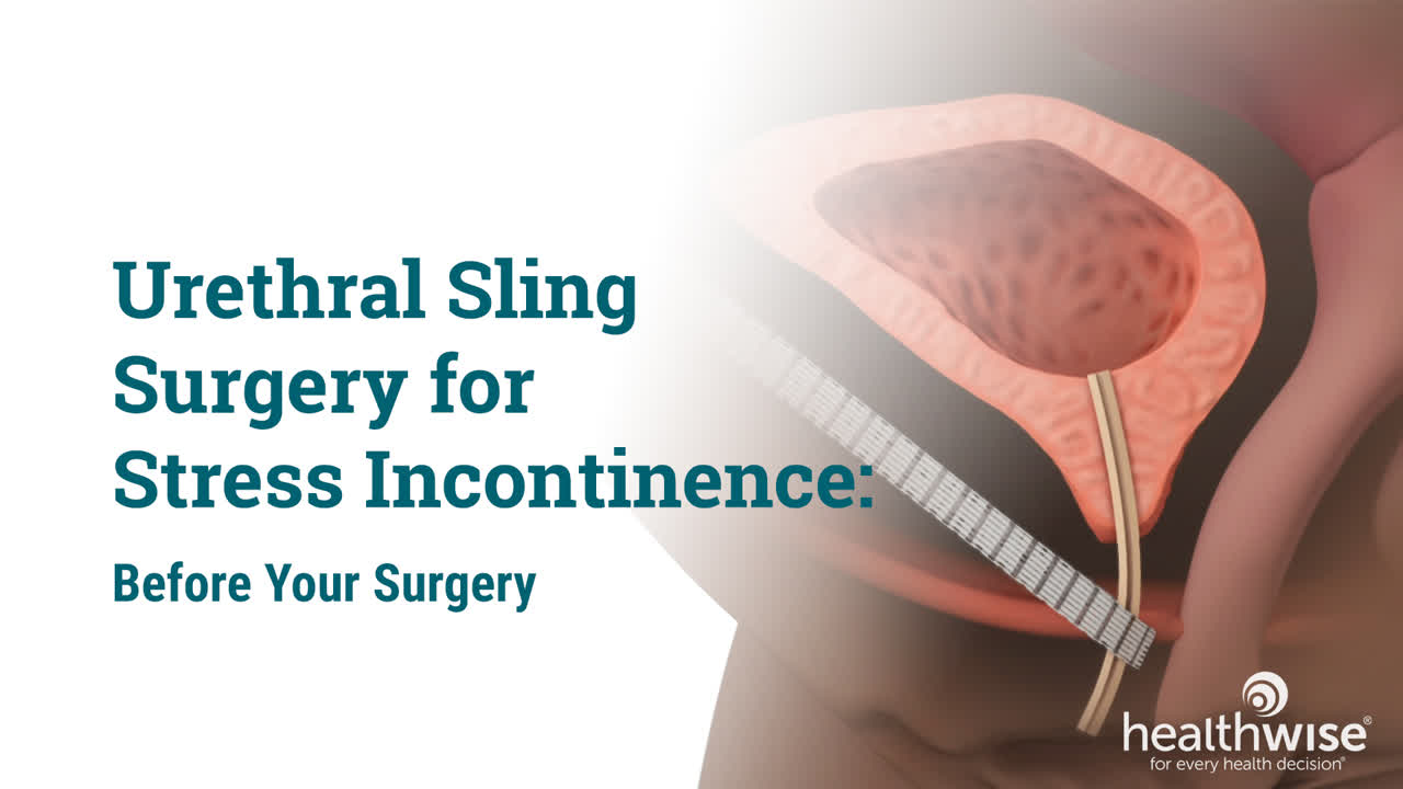 Sling Procedure For Urinary Incontinence