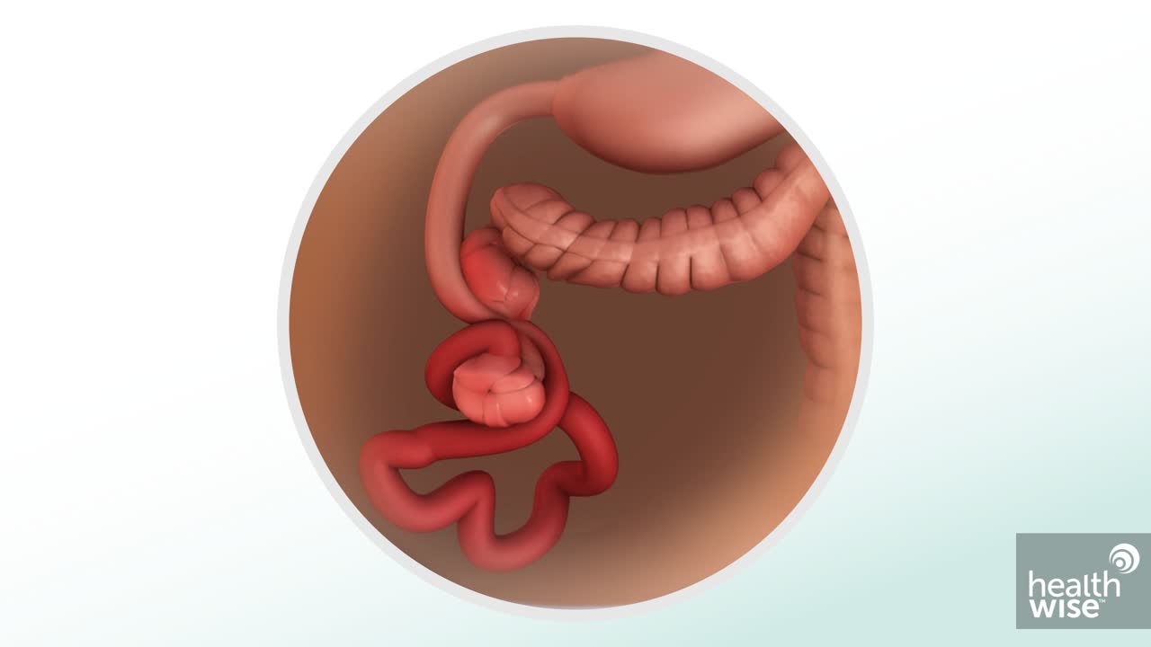 Volvulus Baby