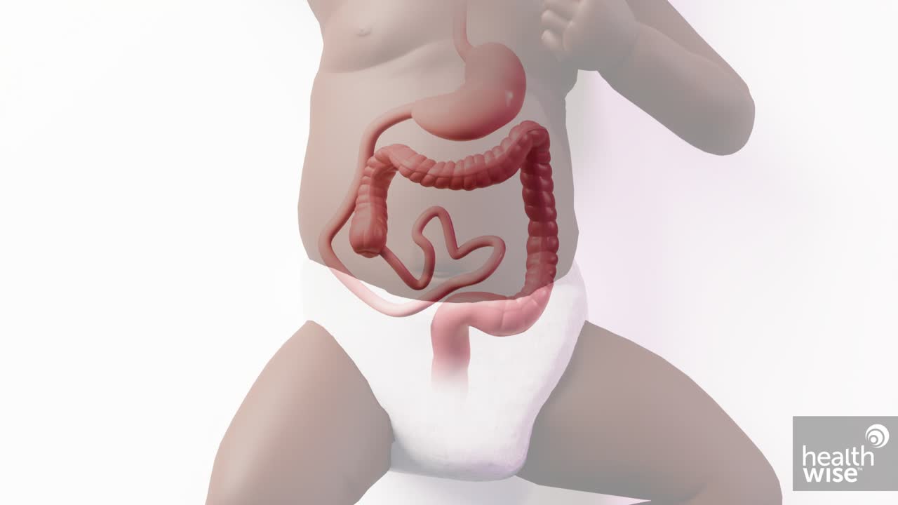 Volvulus Baby Symptoms