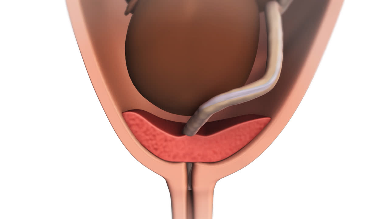 その他 PURETIER PLACENTA Placenta previa: Fast Facts | Kaiser Permanente